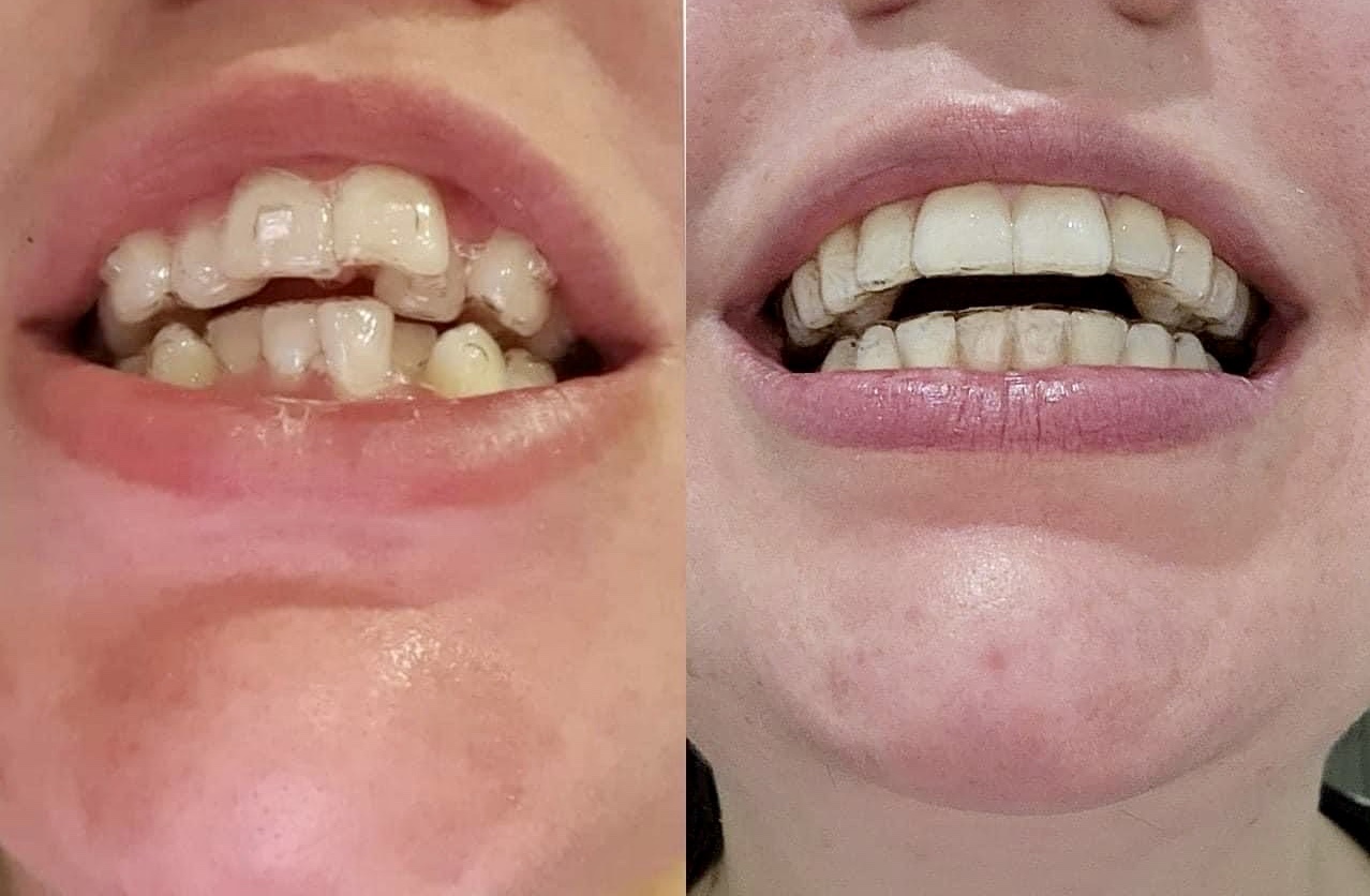 invisalign