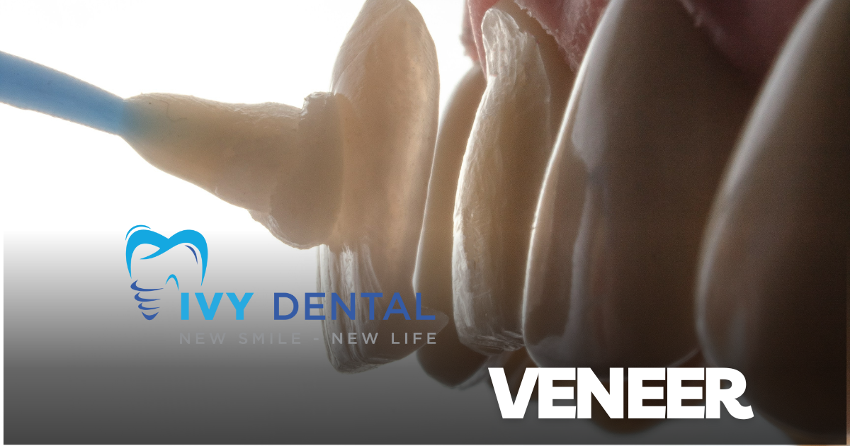 nha khoa ivy - Ưu điểm  Nhược điểm của phương pháp thẩm mỹ Veneer