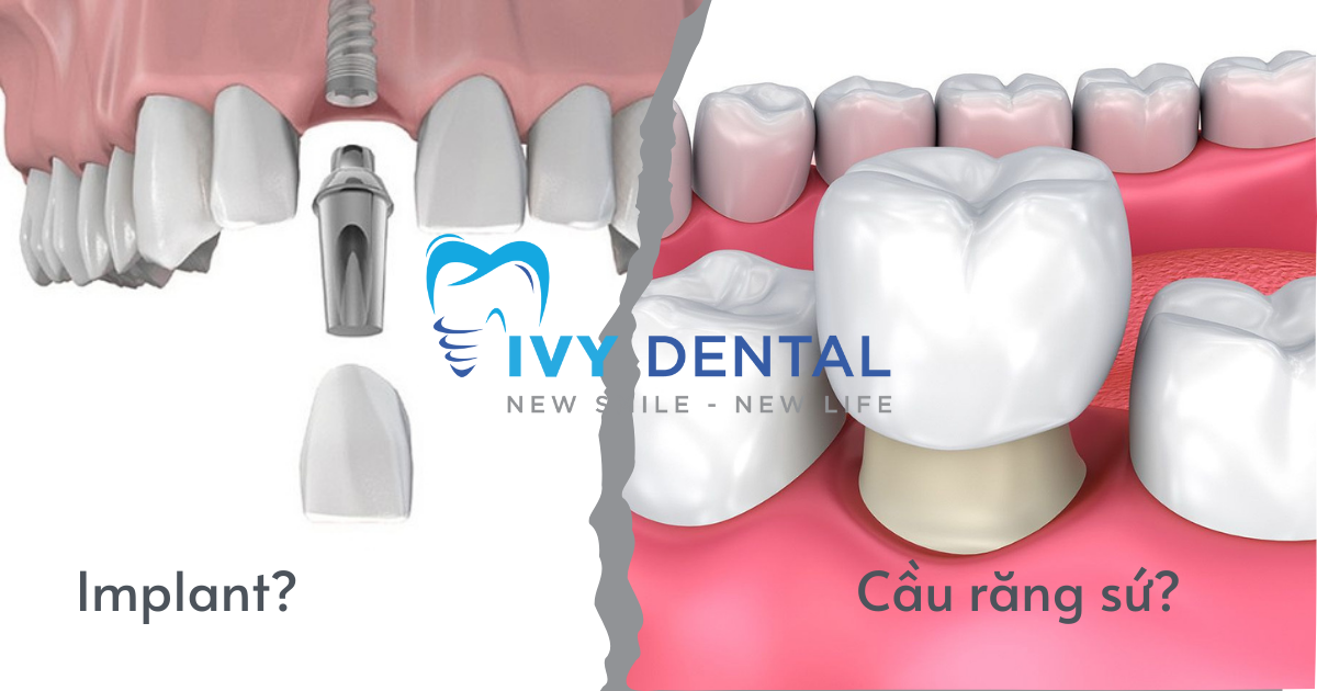 nha khoa ivy - Implant Hay Cầu Răng Sứ Lựa Chọn Nào Tối Ưu Hơn