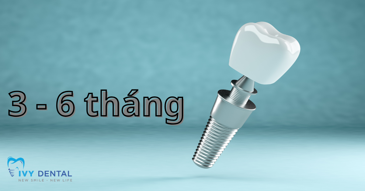nha khoa ivy Thời Gian Cấy Ghép Implant Bao Lâu 