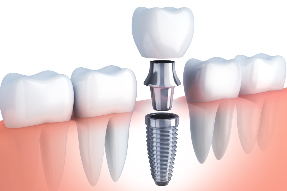 Cấy ghép implant