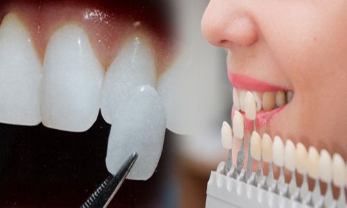 bọc răng sứ có hại gì không
