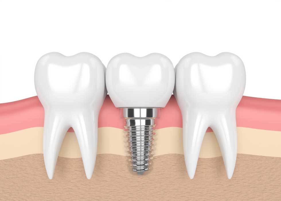 cay-ghep-implant-nha-khoa-ivy