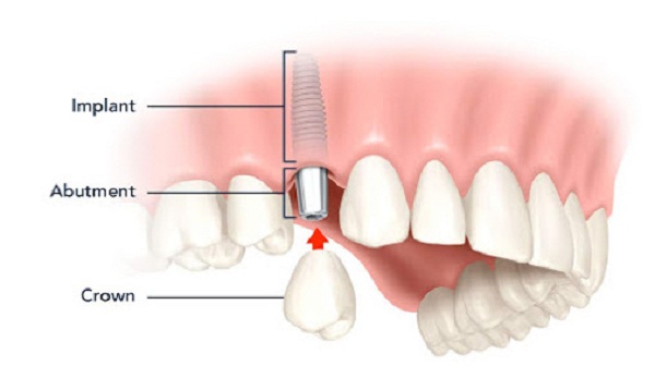 uu-diem-cua-cay-ghep-implant-1