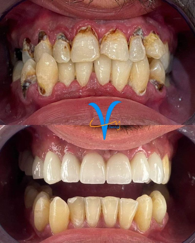 Khi nào thì phải bọc răng sứ? Và các bước thực hiện?