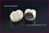 Có Nên Trồng Răng Sứ Không? Những Vấn Đề Không Thể Bỏ Lỡ