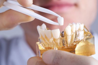 Bảng Giá Cấy Ghép Implant Rẻ Nhất Hiện Nay