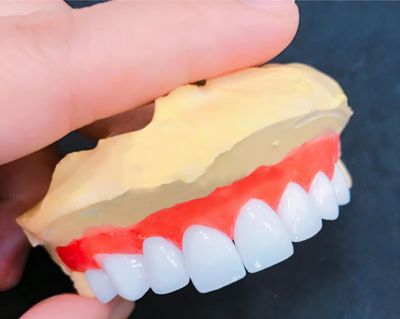 Cách Trồng Răng Sứ Như Thế Nào?