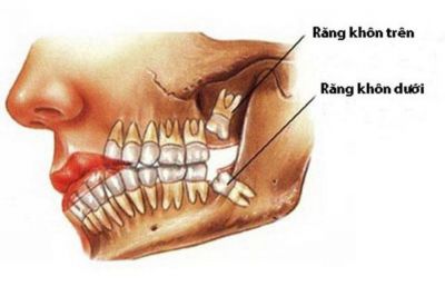 có nên nhổ răng khôn không