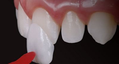 3 PHƯƠNG PHÁP THẨM MỸ RĂNG THƯA HIỆU QUẢ