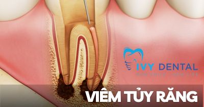 Viêm tủy răng: Nguyên nhân, triệu chứng và cách điều trị hiệu quả | Nha khoa Ivy - Bình Thạnh